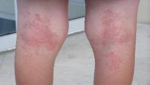 allergy skin rash